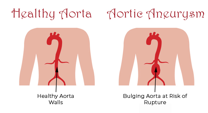 Abdominal Aortic Aneurysm Specialist St Petersburg FL