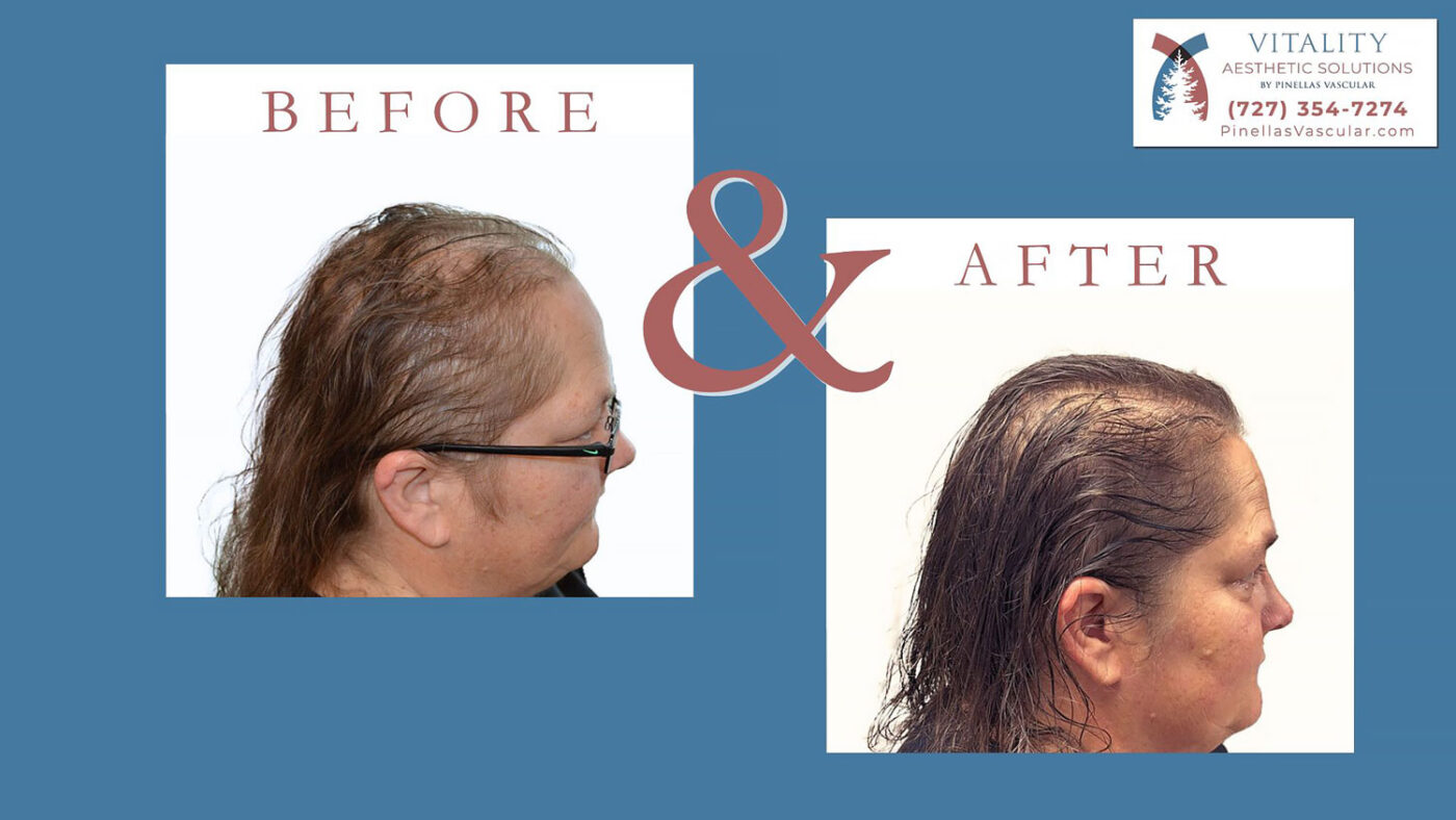 Hair Loss Treatment For Women St Petersburg FL
