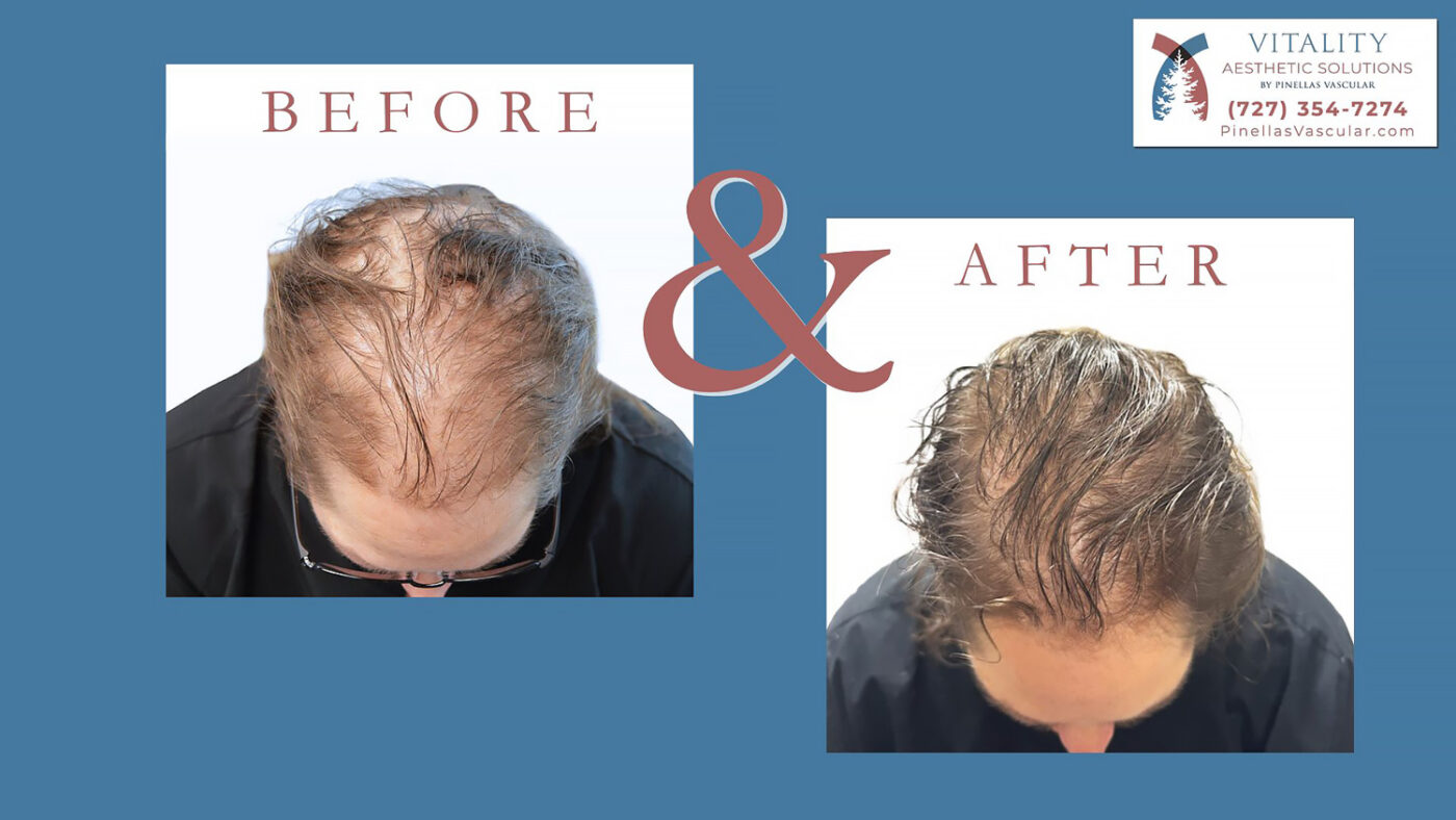 Hair Loss Treatment in St Petersburg FL