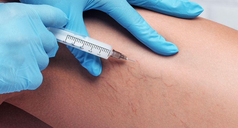 Sclerotherapy Injections St Petersburg FL