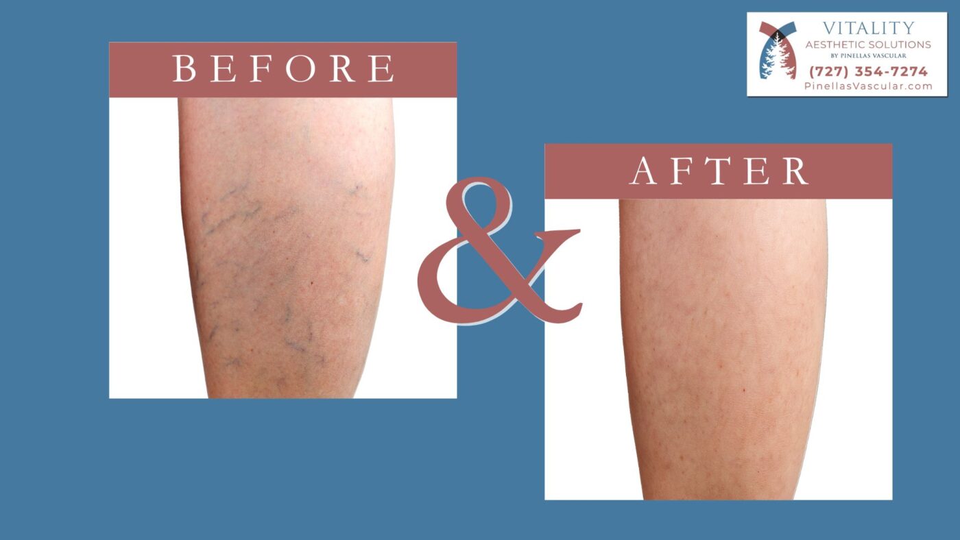 Spider Vein Removal Tampa