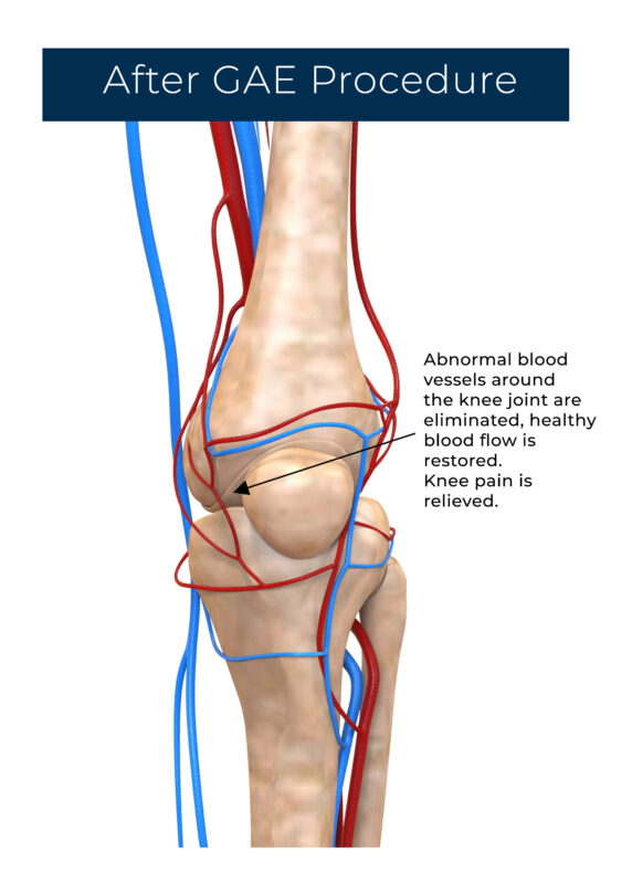 Knee Treatment for Arthritis Pain Tampa