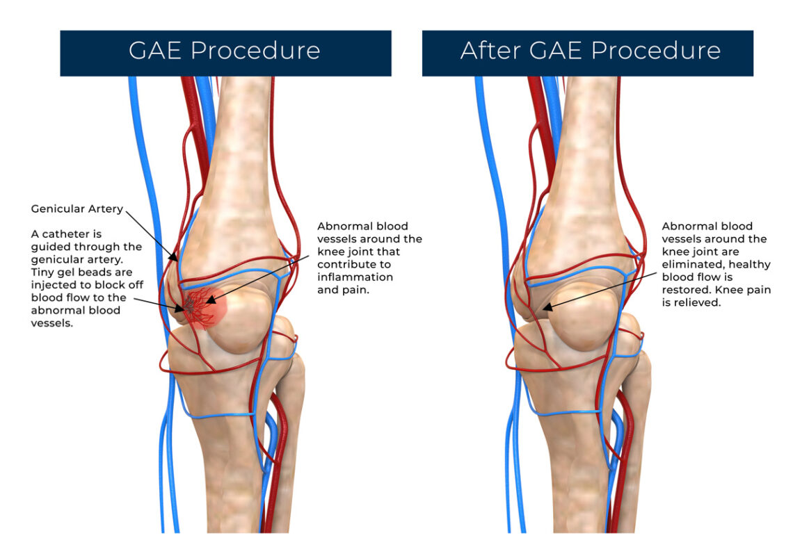 Osteoarthritis Knee Treatment St Pete
