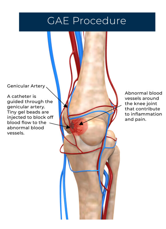 Osteoarthritis Knee Treatment in St Pete