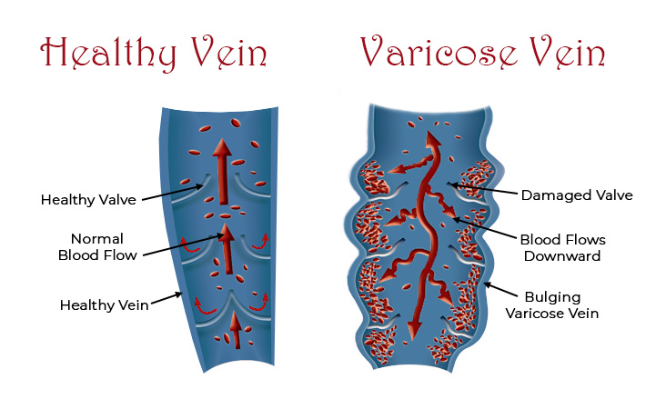 What causes varicose veins to form