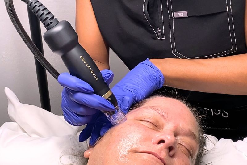Microneedling with Radiofrequency St Pete FL