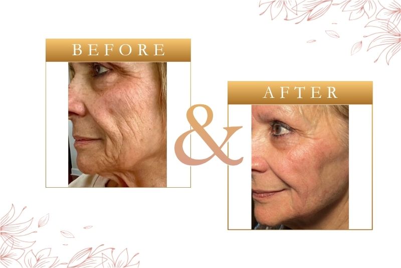 St Pete Laser Skin Tightening