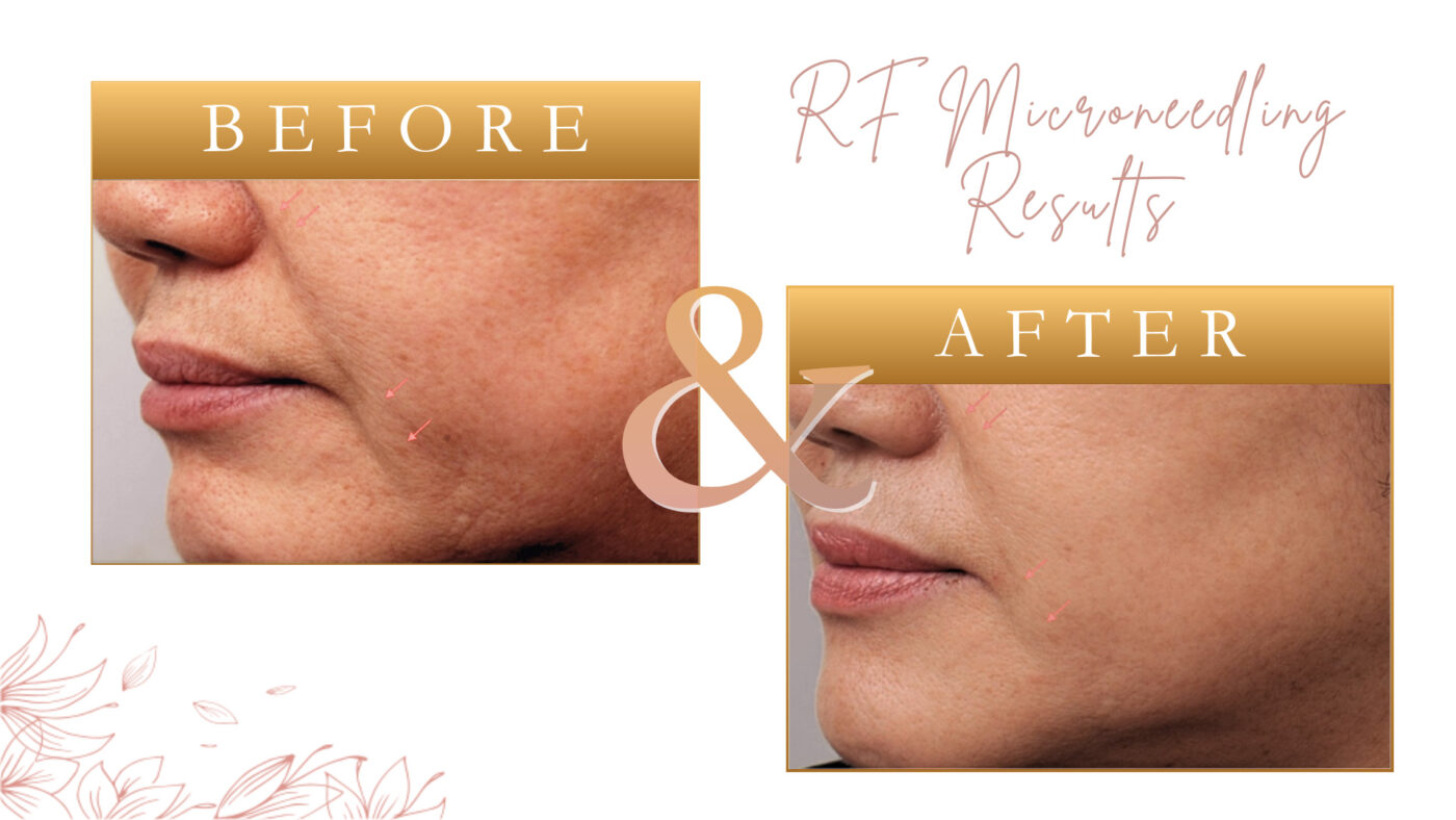 St Petersburg RF Skin Tightening