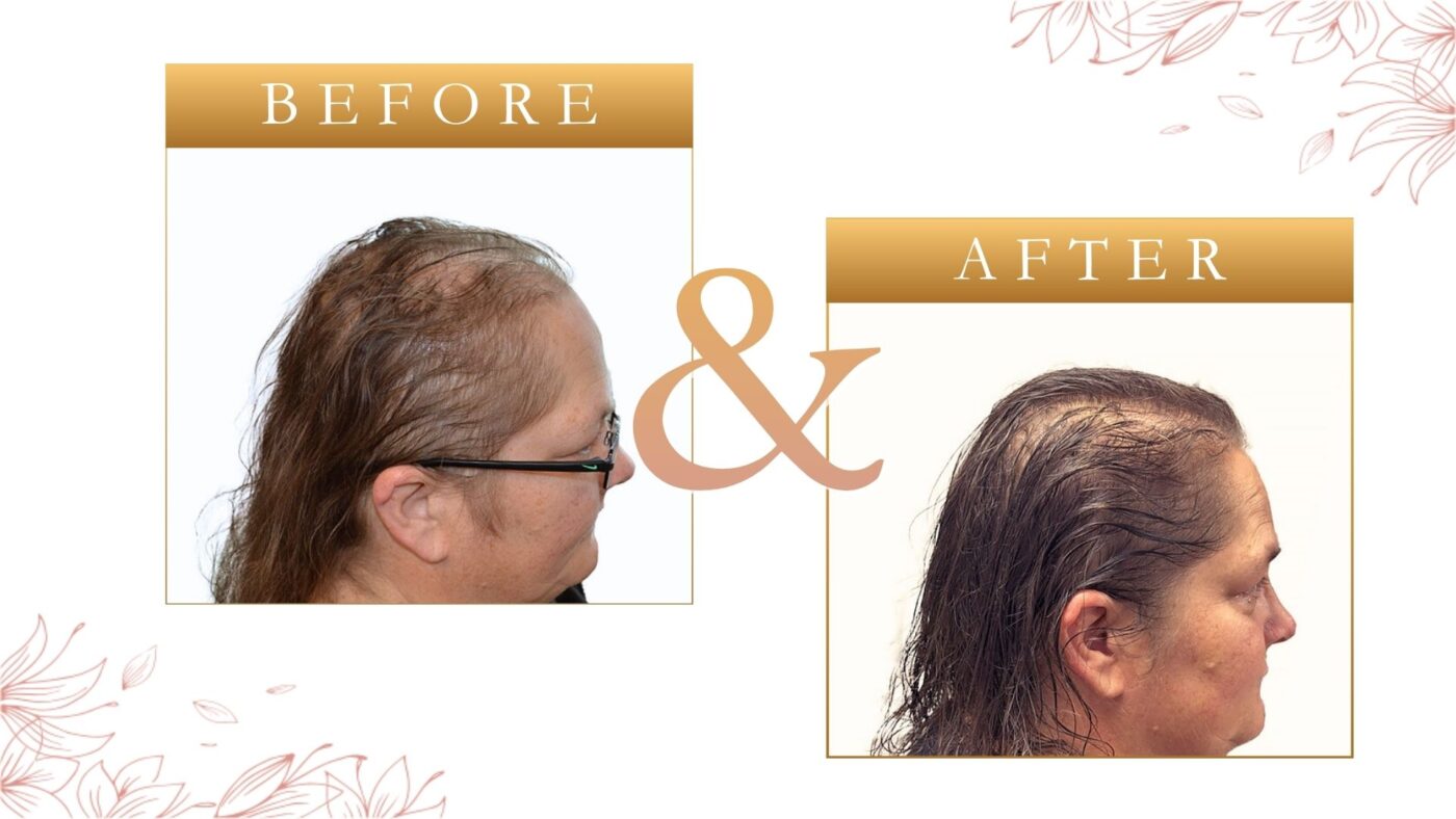 Hair Loss Treatment For Women St Petersburg FL