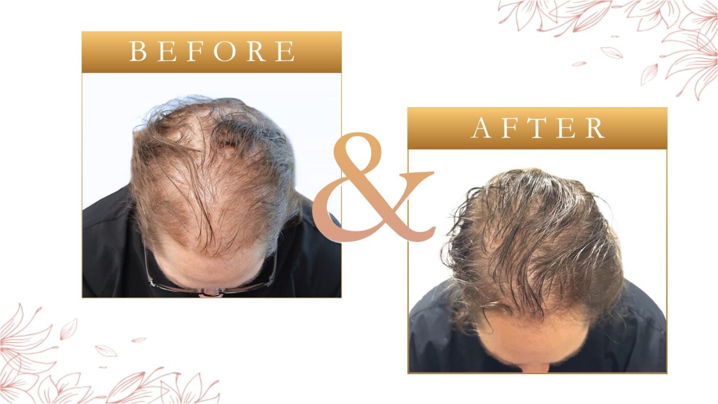 Hair Loss Treatment in St Petersburg FL