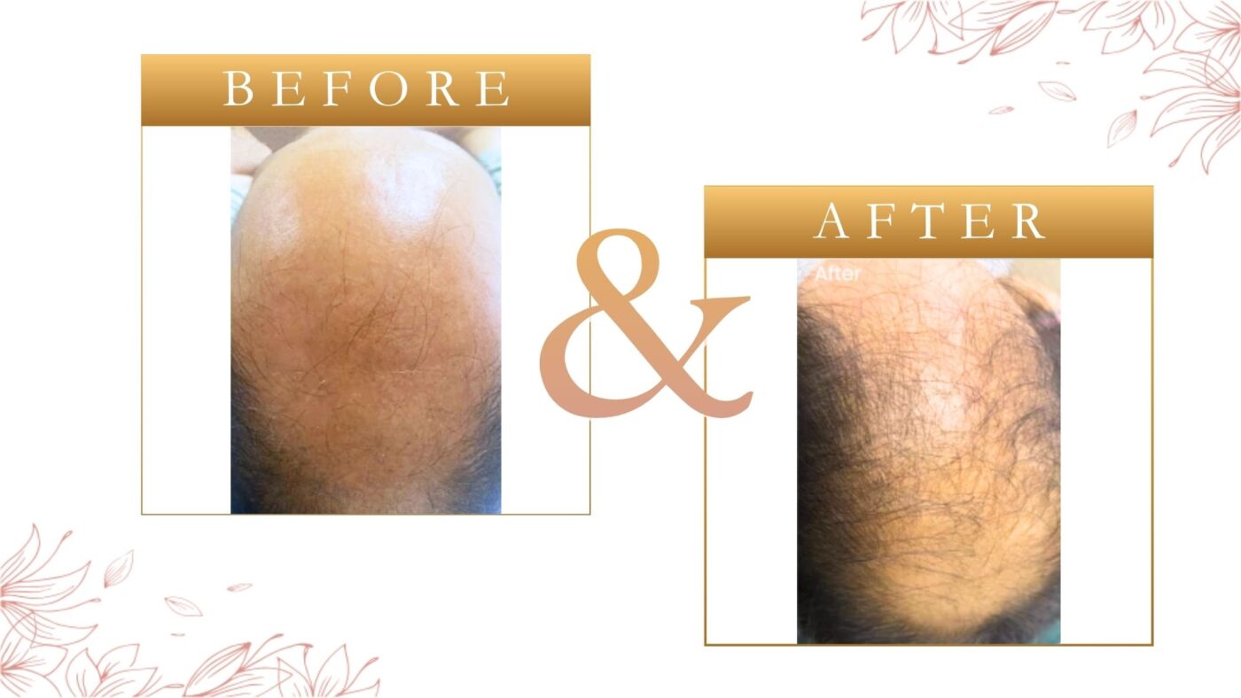 PRP Hair Treatment St Pete FL