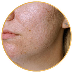 RF Microneedling for Acne Scars St Pete FL
