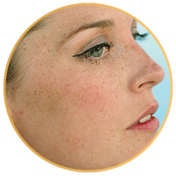 RF Microneedling for Freckles St Pete FL