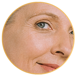 RF Microneedling for Wrinkles St Petersburg FL