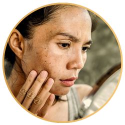 Skin Tone Correction for Melasma Treatment St Petersburg FL