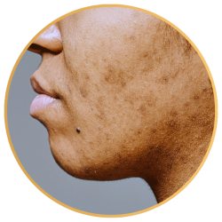 Skin Tone Treatment with Microneedling St Pete FL