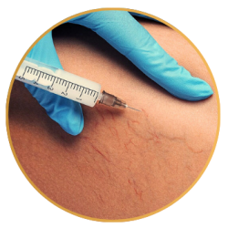 Spider Vein Sclerotherapy Treatments St Pete FL