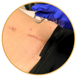 St Petersburg Laser Scar Removal